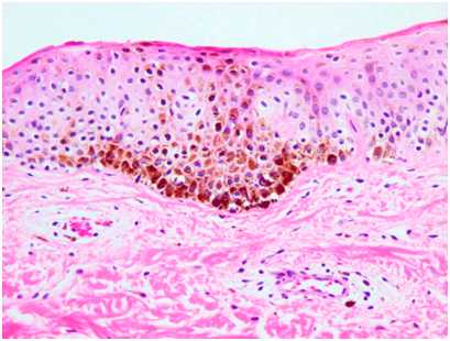 Глубокие пигментации - изменения при мелазме