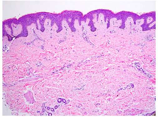 Глубокие пигментации - гистологические изменения в невусе Беккера