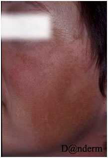 Гиперпигментация мелазма