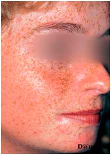 Гиперпигментация - веснушки