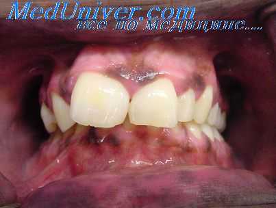 полип толстой кишки