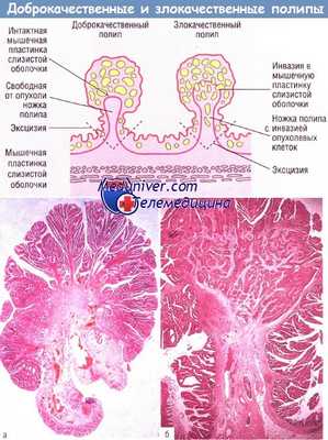 Различия доброкачественного и злокачественного полипов толстой кишки