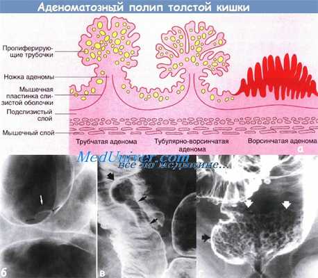 Перерождение полипа в рак