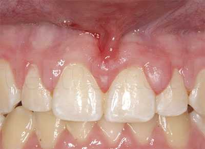 Гиперплазия верхней десны
