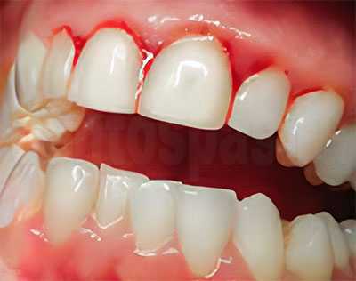 Гиперплазия десны, вызванная гингивитом