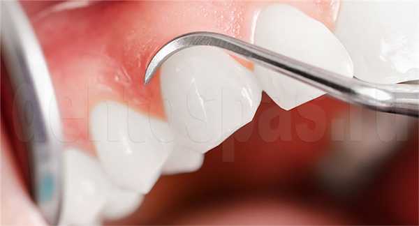 Лечение десен