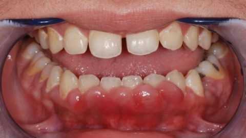 Третья степень гиперплазии десны