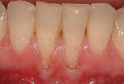 Рецессия десны