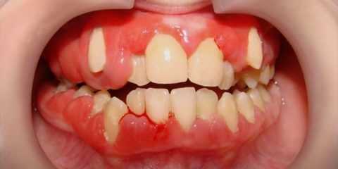 Клиническая картина генерализированной гипертрофии десны