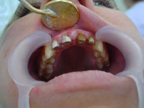 Инструментальный осмотр ротовой полости