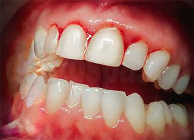 Кровоточивость десен