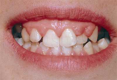 Гиперплазия десны