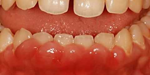 Фото: Гиперплазия десен