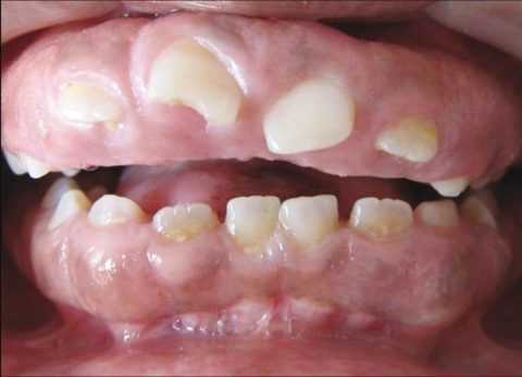 Медикаментозная гиперплазия десен