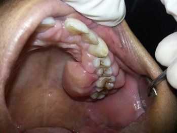 Ограниченная форма гипертрофии десны