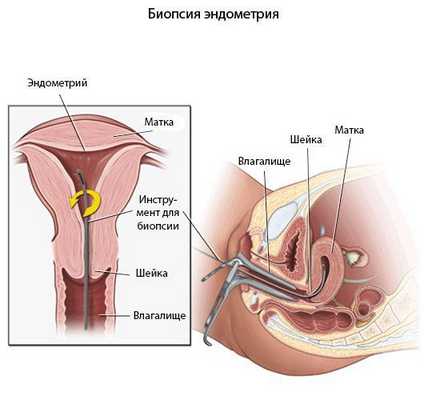 Пайпель-биопсия