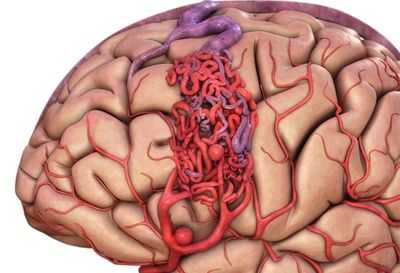 Нарушение деятельности мозна