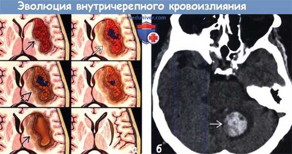Стадии внутричерепного кровоизлияния на КТ