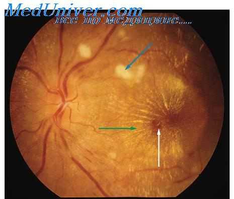 диагностика гипертонического криза