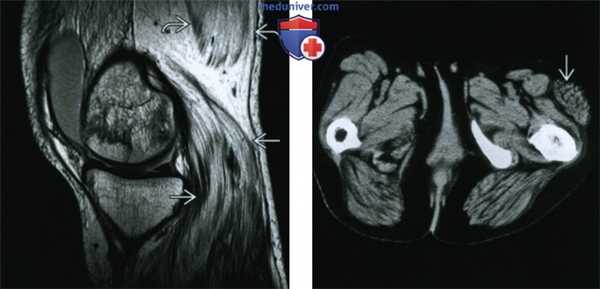 Денервационная гипертрофия - лучевая диагностика