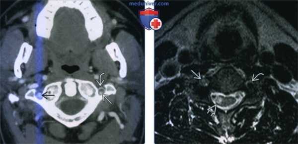 Аневризма позвоночной артерии - лучевая диагностика
