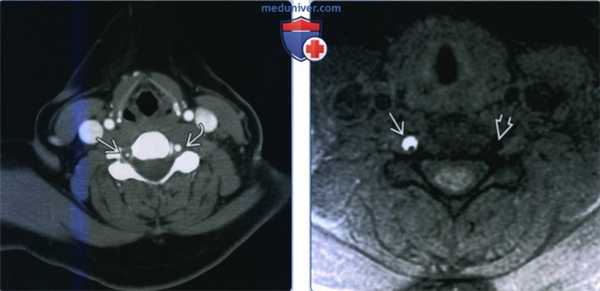 Аневризма позвоночной артерии - лучевая диагностика