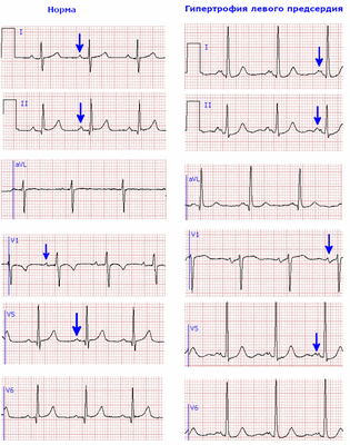 Морфология зубца P в норме и при гипертрофии левого предсердия на кардиограмме.