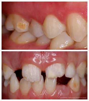 Местная и системная гипоплазия