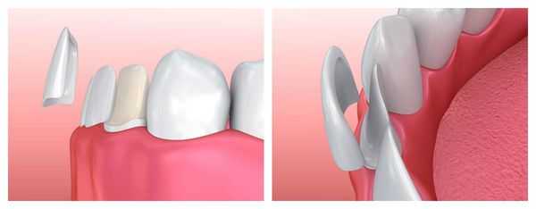 Принцип установки винира