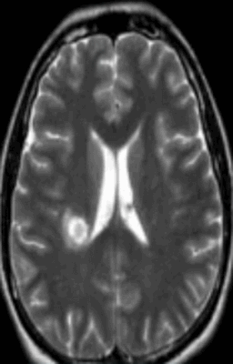 Очаг демиелинизации на МРТ