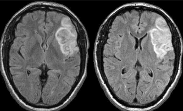 Внутримозговое кровоизлияние на МРТ