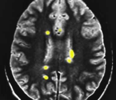 рассеянный склероз в цвете