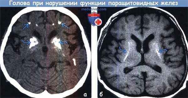 Нарушение функции паращитовидных желез на КТ, МРТ головного мозга