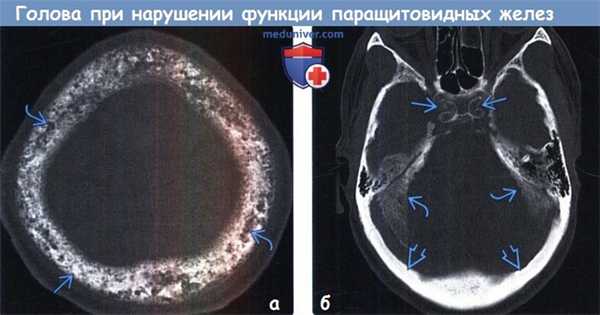 Нарушение функции паращитовидных желез на КТ головного мозга
