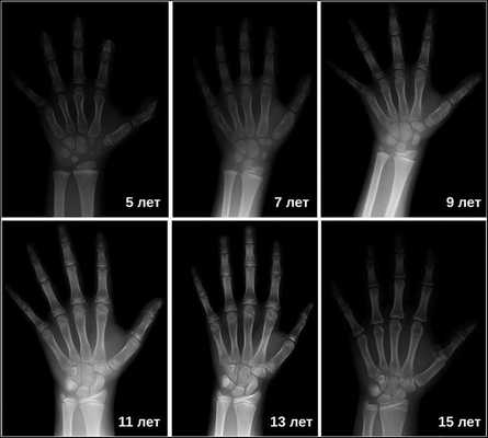 Пример созревания детского скелета