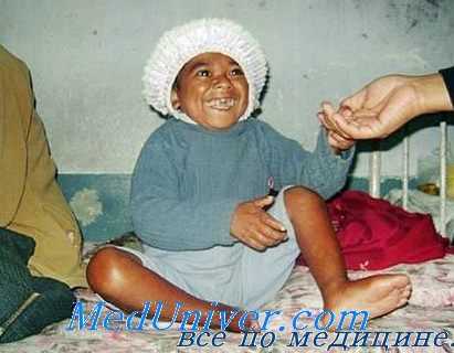 гипопитуитаризм