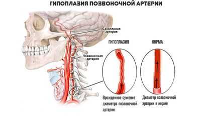 Гипоплазия левой позвоночной артерии