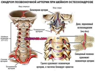 Синдром позвоночной артерии при шейном остеохондрозе