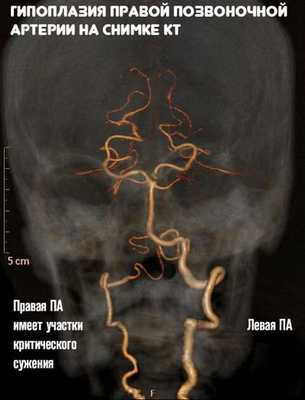 Гипоплазия