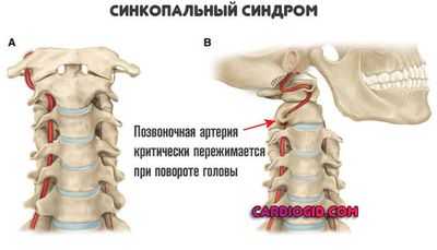синкопальный-синдром