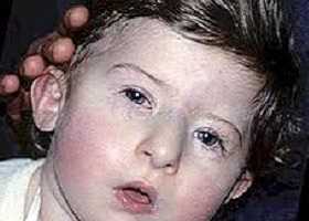 Синдром Ди Джорджи