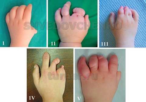 Основные варианты клинических форм вторичной эктродактилии кисти