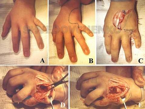 Устранение ульнарной клинодактилии 5 пальца при конкресценции 4-5 пястных костей, А-вид кисти до операции, В – схема кожного разреза, D,Е – остеотомия зоны синостоза, С – вид кисти после устранения клинодактилии и закрытия межпястного промежутка