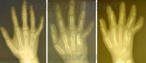 Тератологический ряд ульнарной гипоплазии кисти