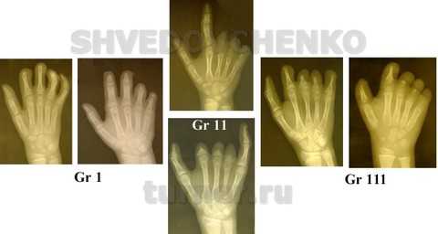 Основные варианты эктродактилии кисти