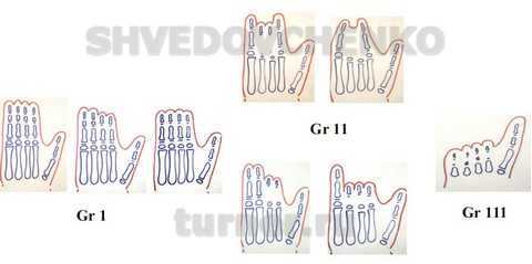 Тератологический ряд врожденной брахидактилии кисти