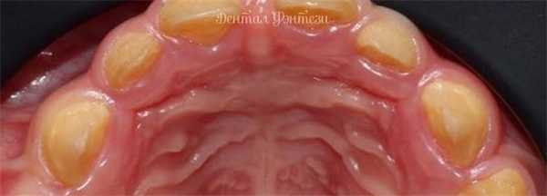 Несовершенный амелогенез. Восстановление зубов коронками