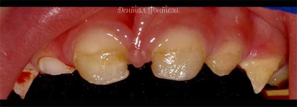 Несовершенный амелогенез. Восстановление зубов коронками