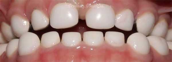 Несовершенный амелогенез. Восстановление зубов коронками