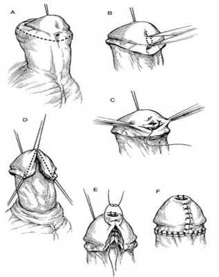 Хирургическое лечение гипоспадии